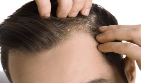 چرا سرم شوره می زند؟