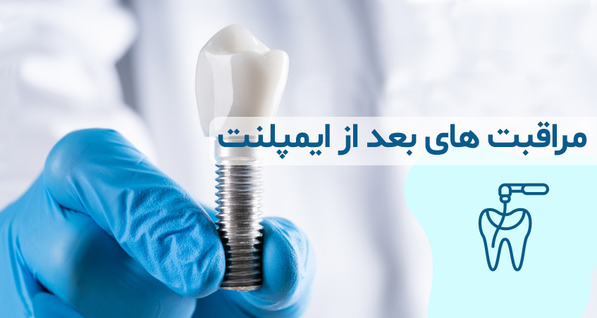 مراقبت‌های بعد از ایمپلنت دندان