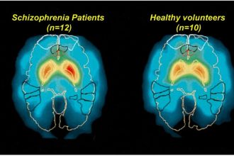 تشخیص دقیق اسکیزوفرنی با هوش مصنوعی BrainProbe در تایوان