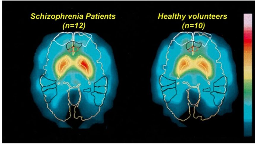 تشخیص دقیق اسکیزوفرنی با هوش مصنوعی BrainProbe در تایوان