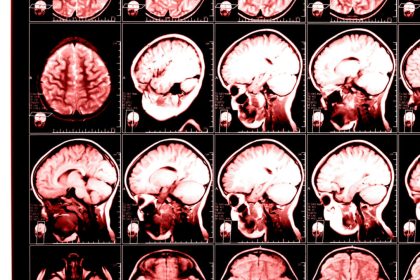 تغییرات مغز