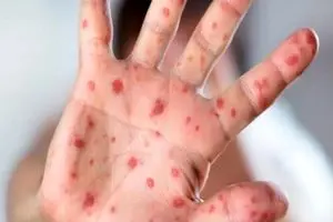 ثبت مواردی از سرخک در 4 ماه نخست سال جاری/ زنگ خطر در شمال کشور