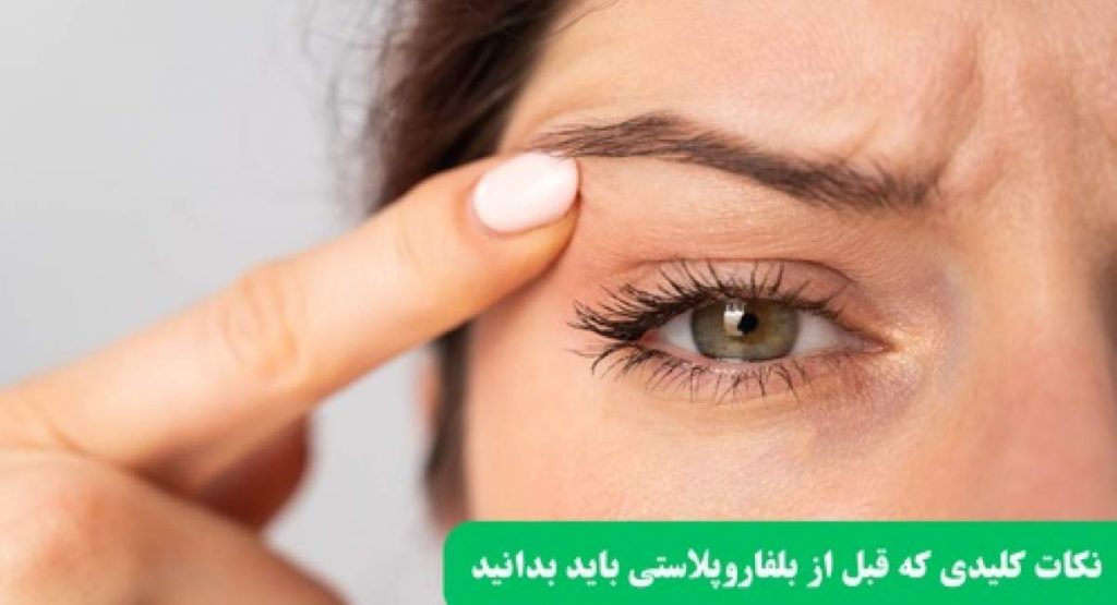 نکات کلیدی که قبل از بلفاروپلاستی باید بدانید