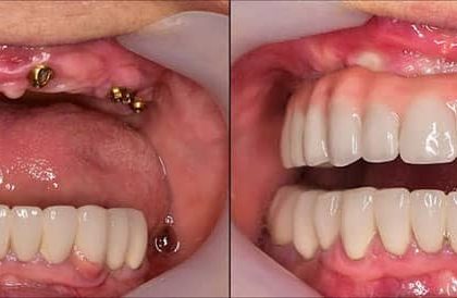 آینده دندانپزشکی: از درمانهای سنتی تا فناوریهای شگفتانگیز 2 what is Overdenture