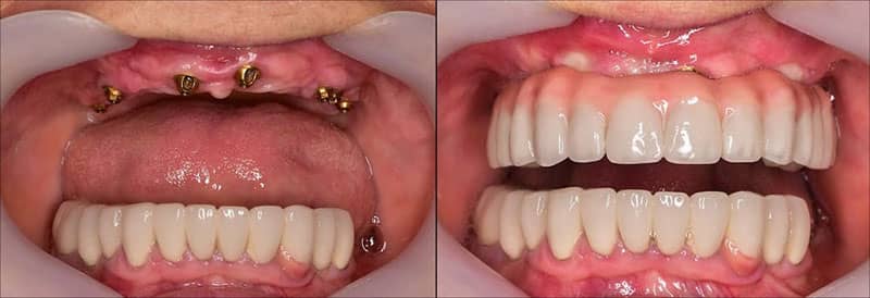 what is Overdenture