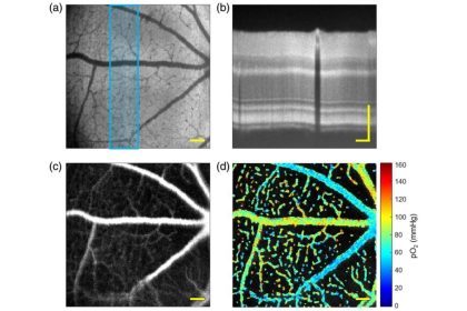 فناوری تصویربرداری جدید برای شناسایی زودهنگام بیماری‌های چشم
