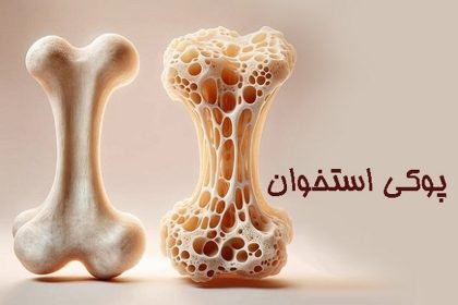 این افراد در خطر پوکی استخوان اند!/ قطعی‌ترین روش برای تشخیص و درمان پوکی استخوان
