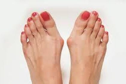 2 عامل مهم که نقش مهمی در ایجاد انحراف شست پا دارند